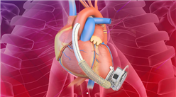 首個全磁懸浮式人工心臟獲批！中國心臟瓣膜市場數據預測分析（圖）