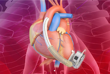 首个全磁悬浮式人工心脏获批！中国心脏瓣膜市场数据预测分析（图）